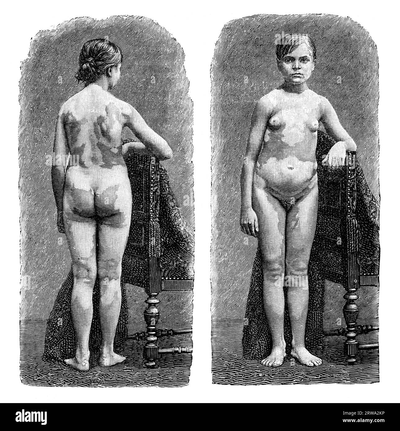 La vitiligine è una patologia cronica che causa la depigmentazione in macchie di pelle. Vecchia illustrazione medica di Lehrbuch der Haut- und Foto Stock