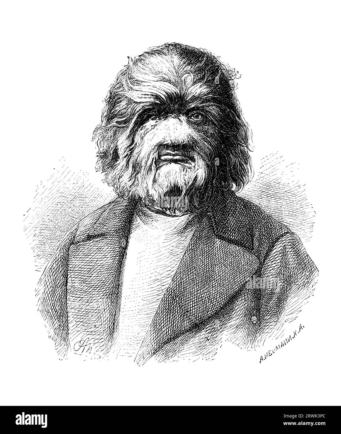 Adrian Yeftichev. Un uomo russo che soffre di ipertricosi. Vecchia illustrazione medica da Lehrbuch der Haut- und Geslechtskrankheiten del Dr. Foto Stock