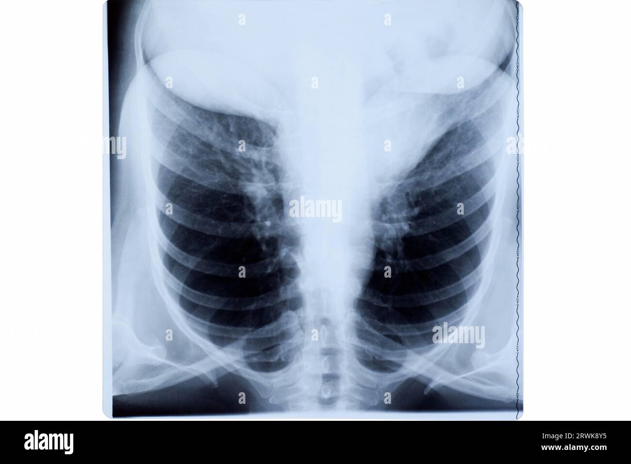 Radiografia del torace della donna matura Foto Stock
