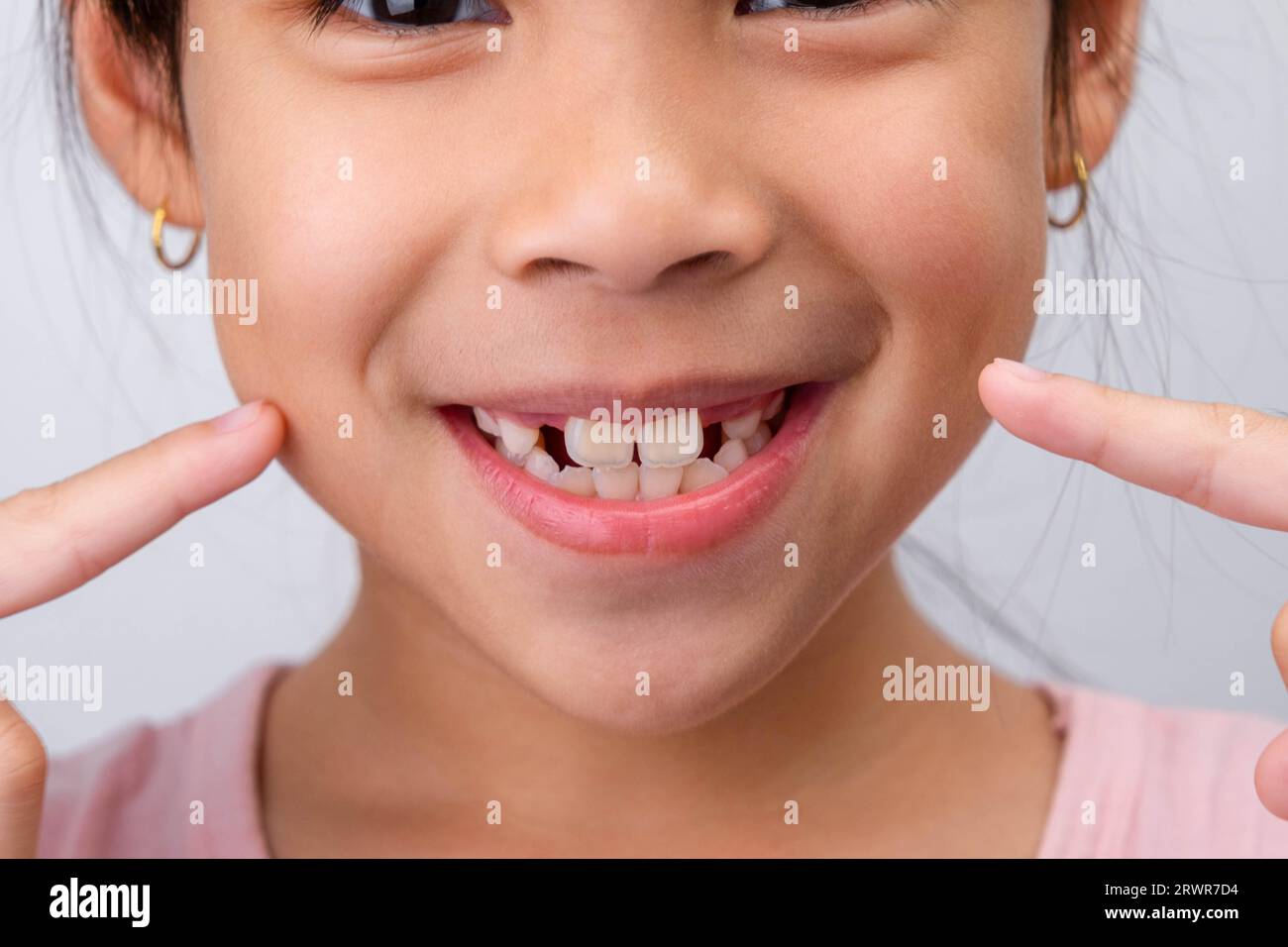 Primo piano di una ragazza simpatica che sorride in grande, mostrando uno spazio vuoto con i primi denti anteriori in crescita. Ragazzina con un grande sorriso e senza denti di latte. Denta Foto Stock