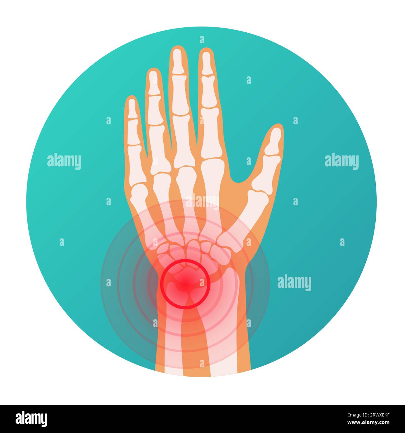 Localizzazione del dolore al cerchio rosso in lesioni della mano umana al polso, scheletro, articolazioni e vettori ossei Illustrazione Vettoriale