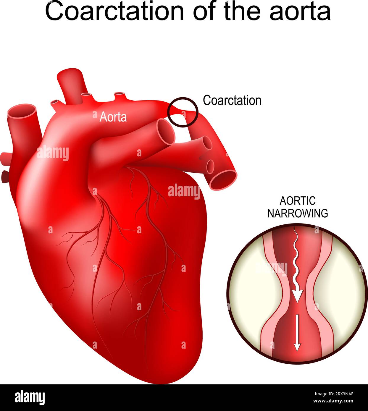 Coartazioni aortiche. Difetto cardiaco congenito. Primo piano della sezione trasversale del restringimento aortico. Anomalie cardiovascolari. Stenosi dell'aorta. vect Illustrazione Vettoriale