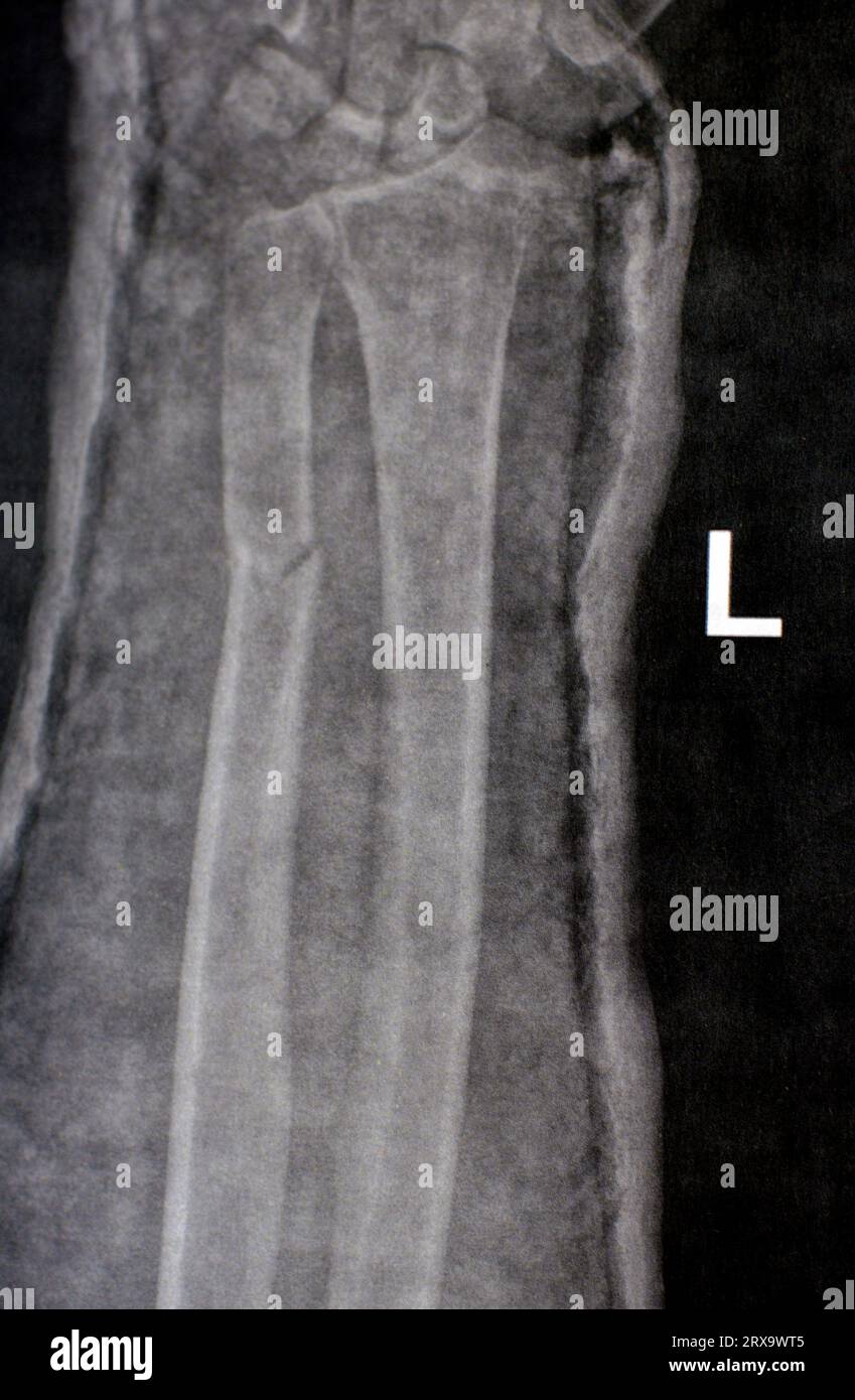 Radiografia semplice dell'avambraccio destro (erroneamente scritta a sinistra sul film) che mostra fratture della parte inferiore dell'ulna in cast per 4 settimane e ha iniziato a guarire Foto Stock