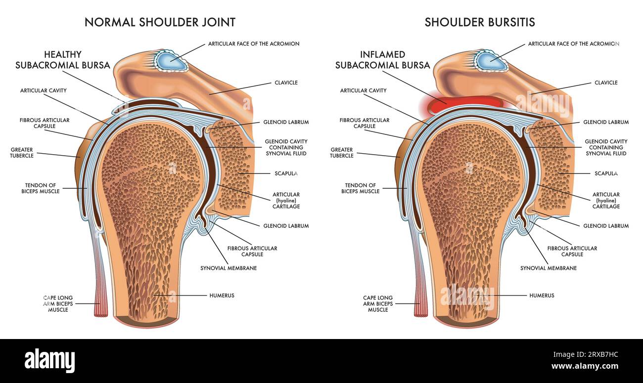 Illustrazione medica che confronta una spalla normale con una borsite della spalla, con annotazioni. Illustrazione Vettoriale