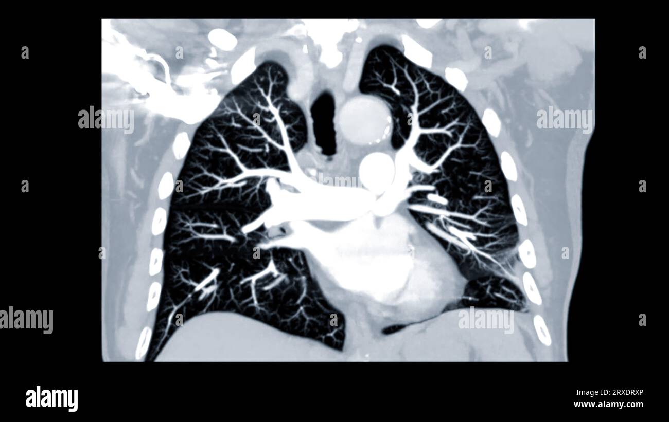 Arteria polmonare CTPA o CTA per embolia polmonare diagnostica (PE), cancro polmonare e covid-19. . Foto Stock