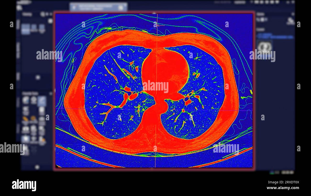 Scansione TC della vista coronale torace in modalità colore per embolia polmonare diagnostica (PE), cancro polmonare e covid-19. Foto Stock