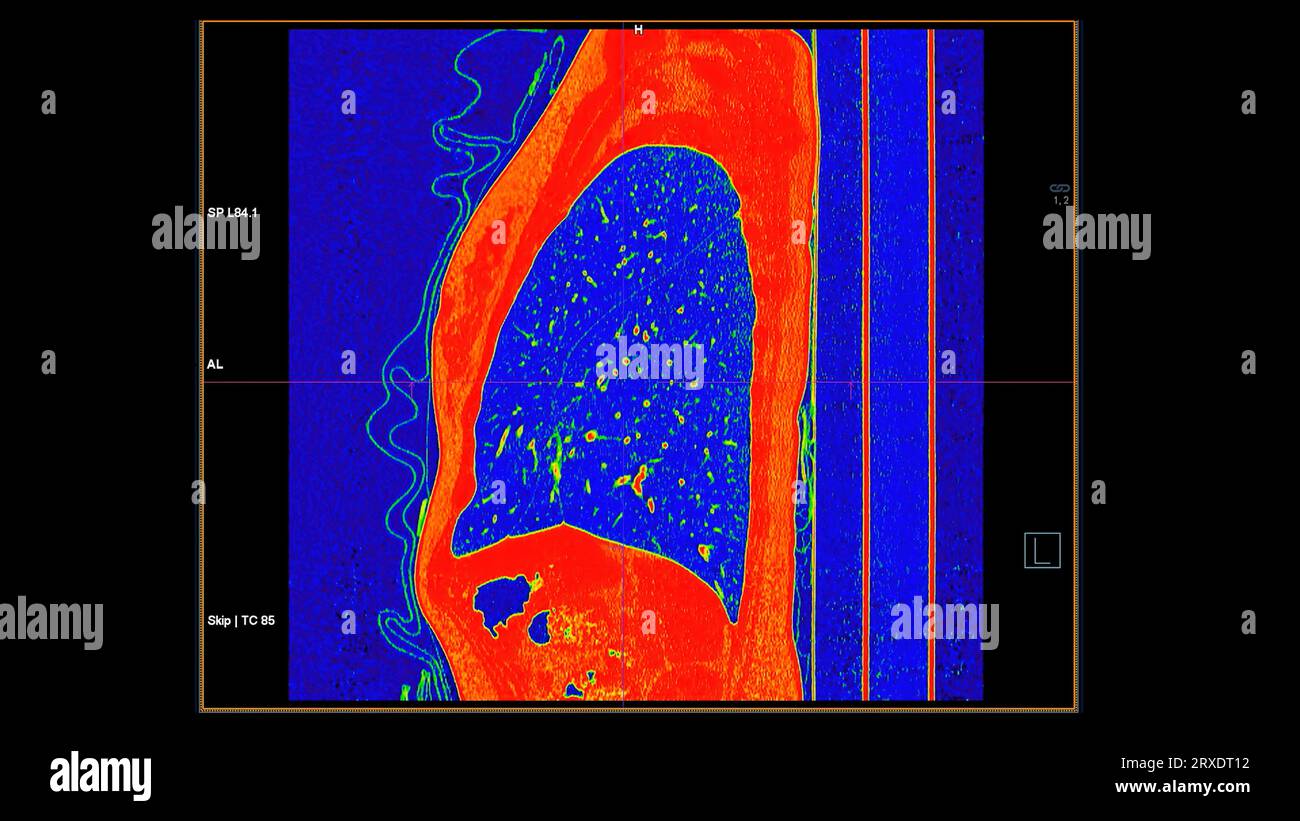 Scansione TC della vista coronale torace in modalità colore per embolia polmonare diagnostica (PE), cancro polmonare e covid-19. Foto Stock