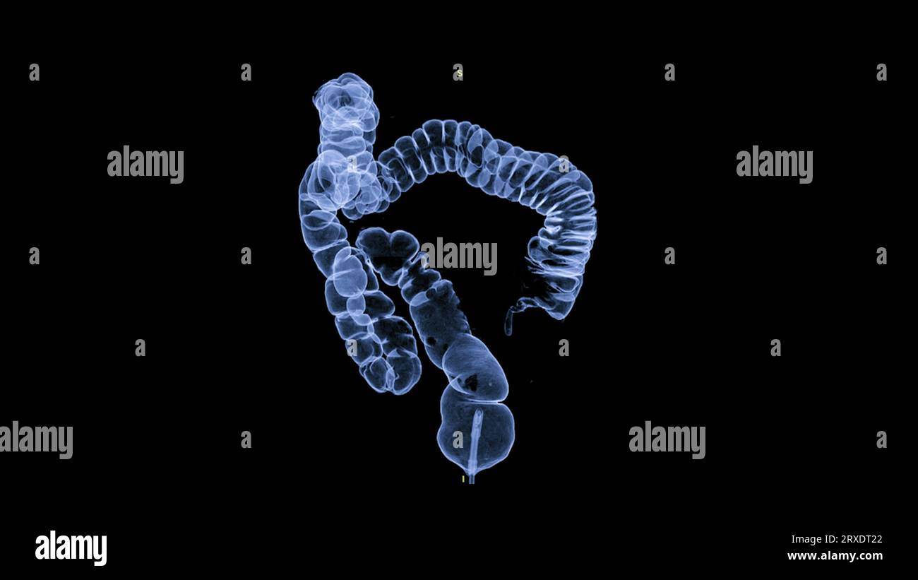 Immagine di rendering 3D della colonografia TC per controlli annuali dello stato di salute per lo screening per il cancro del colon. Foto Stock