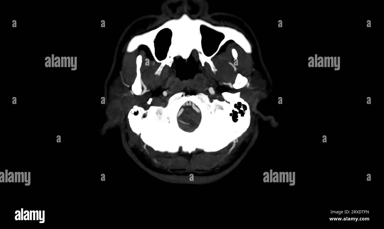 Angiografia CTA CEREBRALE o TC della vista mip assiale cerebrale che mostra l'arteria cerebrale. Foto Stock