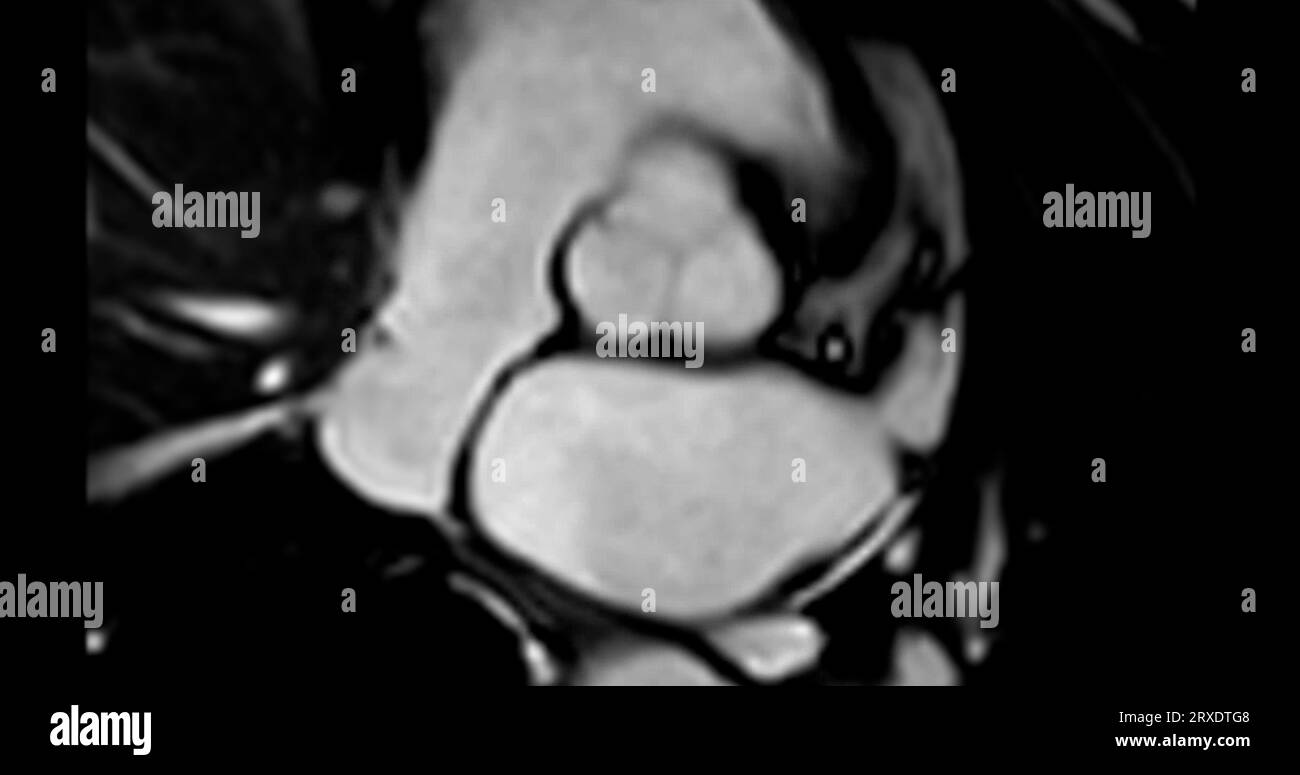 RM cardiaca o RM cardiaca ( risonanza magnetica ) del cuore che mostra la valvola aortica . Foto Stock
