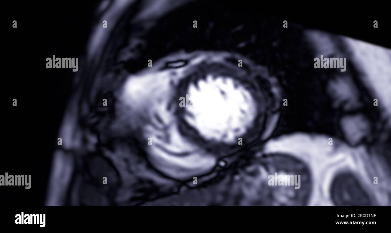MRI Heart o Cardiac MRI ( risonanza magnetica ) del cuore in vista asse corto che mostra battito cardiaco di 2 camere per rilevare la malattia cardiaca. Foto Stock