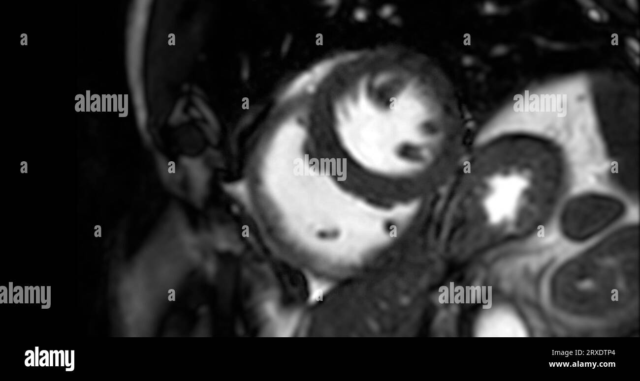 MRI Heart o Cardiac MRI ( risonanza magnetica ) del cuore in vista asse corto che mostra battito cardiaco di 2 camere per rilevare la malattia cardiaca. Foto Stock