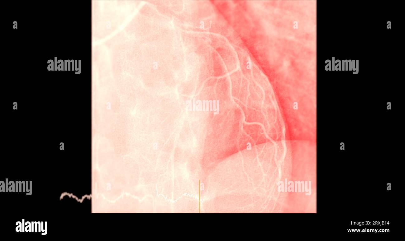 Il cateterismo cardiaco sull'arteria discendente anteriore sinistra (LAD) può aiutare il medico a diagnosticare e trattare i problemi del cuore e dei vasi sanguigni come Foto Stock