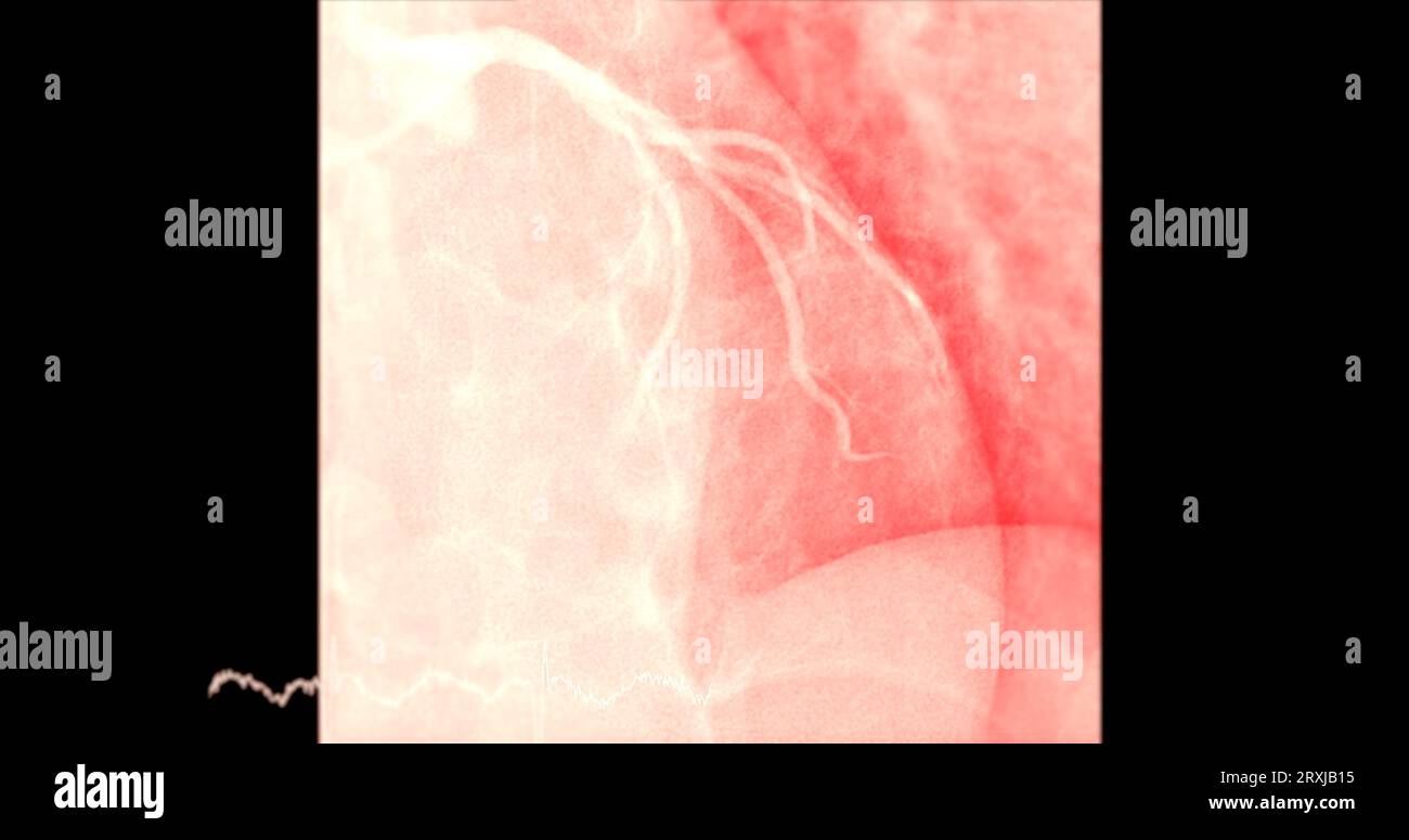 Il cateterismo cardiaco sull'arteria discendente anteriore sinistra (LAD) può aiutare il medico a diagnosticare e trattare i problemi del cuore e dei vasi sanguigni come Foto Stock