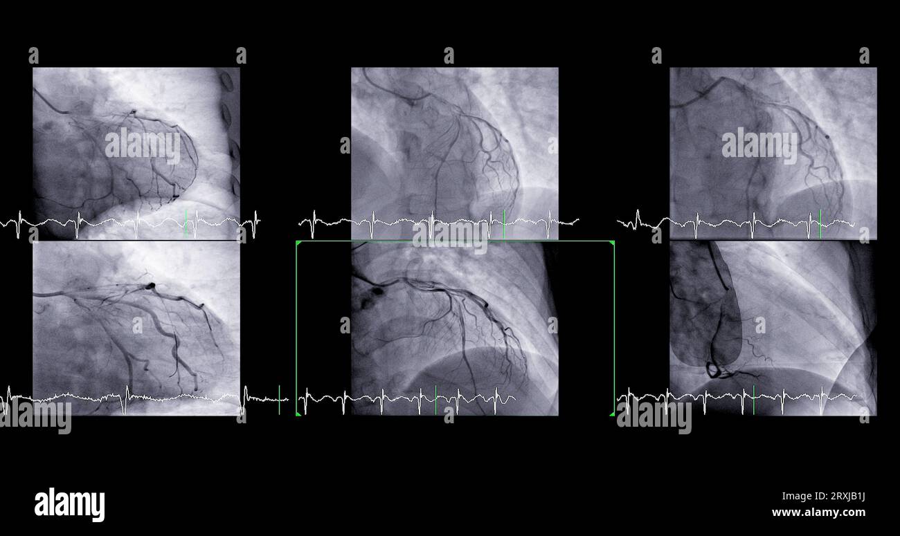 Il cateterismo cardiaco può aiutare il medico a diagnosticare e trattare i problemi del cuore e dei vasi sanguigni che potrebbero altrimenti causare problemi più gravi, come Foto Stock