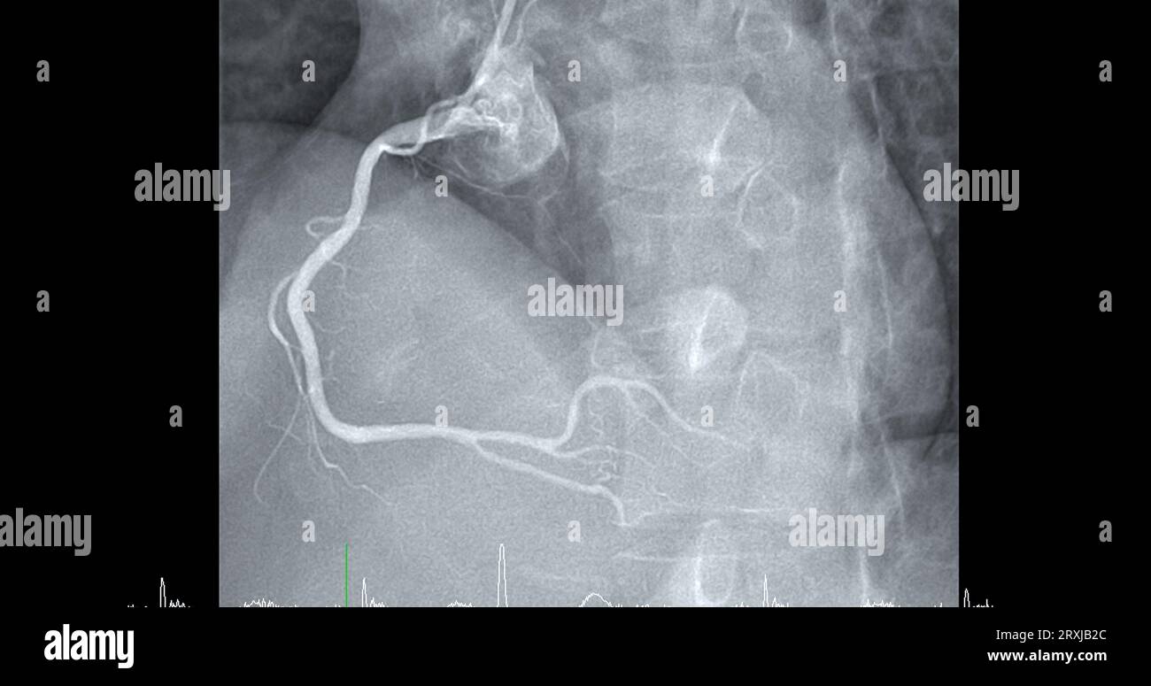 Il cateterismo cardiaco sull'arteria coronaria destra (RCA) può aiutare il medico a diagnosticare e trattare i problemi del cuore e dei vasi sanguigni come un cuore AT Foto Stock