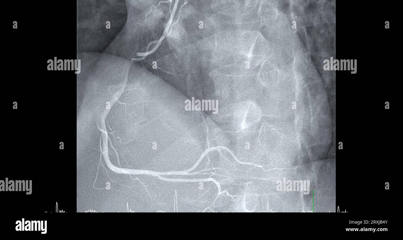 Il cateterismo cardiaco sull'arteria coronaria destra (RCA) può aiutare il medico a diagnosticare e trattare i problemi del cuore e dei vasi sanguigni come un cuore AT Foto Stock