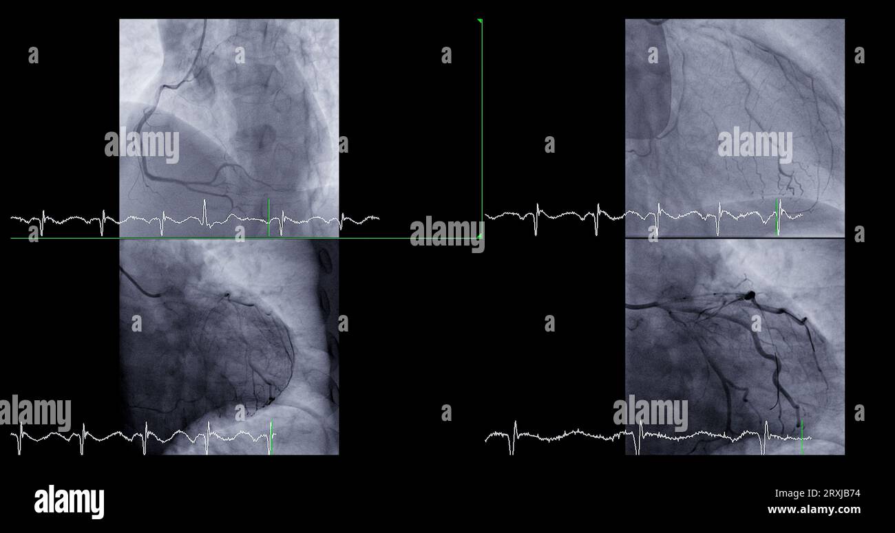 Il cateterismo cardiaco può aiutare il medico a diagnosticare e trattare i problemi del cuore e dei vasi sanguigni che potrebbero altrimenti causare problemi più gravi, come Foto Stock