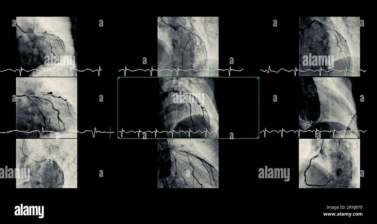 Il cateterismo cardiaco può aiutare il medico a diagnosticare e trattare i problemi del cuore e dei vasi sanguigni che potrebbero altrimenti causare problemi più gravi, come Foto Stock