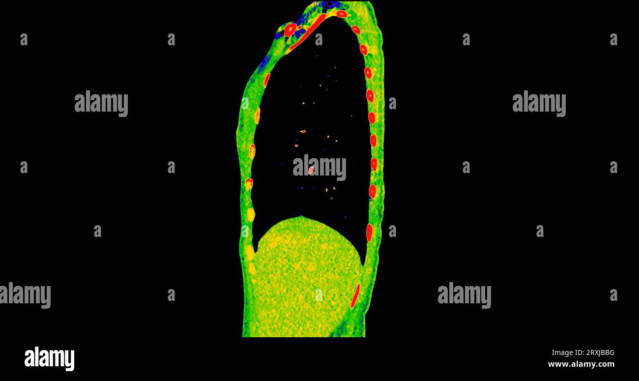 Scansione TC della vista sagittale torace in modalità colore per embolia polmonare diagnostica (PE), cancro polmonare e covid-19. Foto Stock