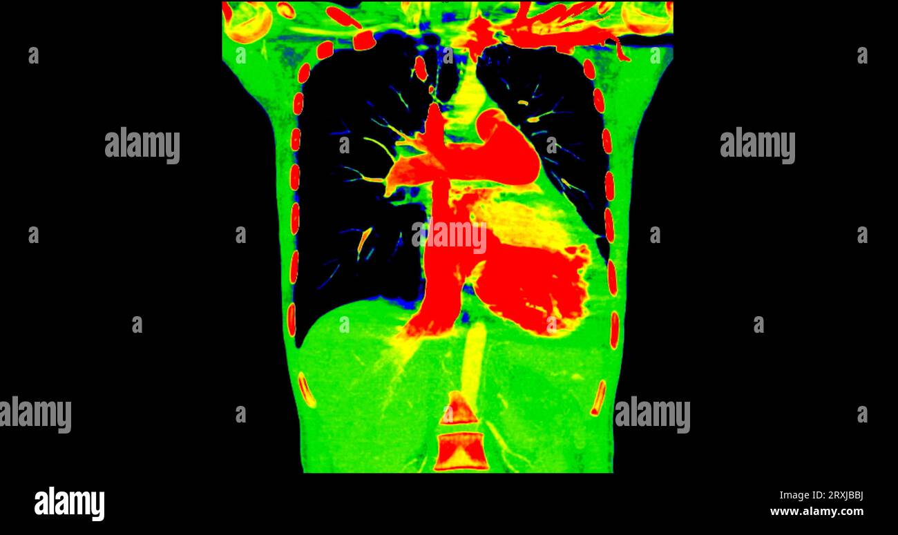 Scansione TC della vista coronale torace in modalità colore per embolia polmonare diagnostica (PE), cancro polmonare e covid-19. Foto Stock