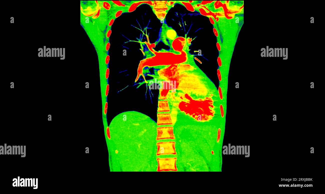 Scansione TC della vista coronale torace in modalità colore per embolia polmonare diagnostica (PE), cancro polmonare e covid-19. Foto Stock