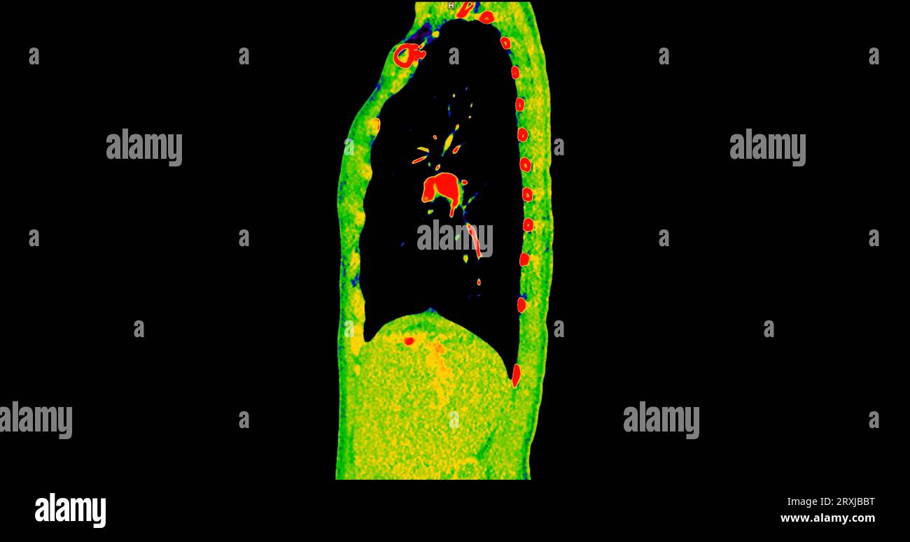 Scansione TC della vista sagittale torace in modalità colore per embolia polmonare diagnostica (PE), cancro polmonare e covid-19. Foto Stock
