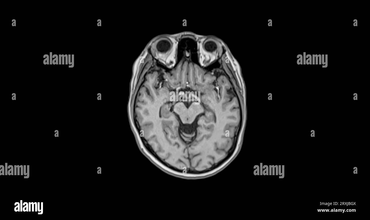 MRI cervello scansione vista assiale per rilevare le malattie cerebrali sush come ictus malattia, tumori cerebrali e infezioni. Foto Stock