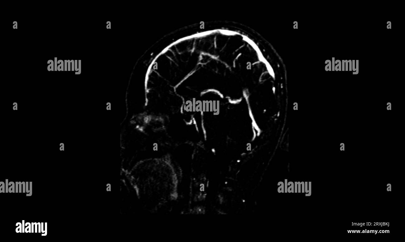 MRV cervello o risonanza magnetica venografia del cervello per la diagnosi anomalie nel drenaggio venoso del cervello Foto Stock