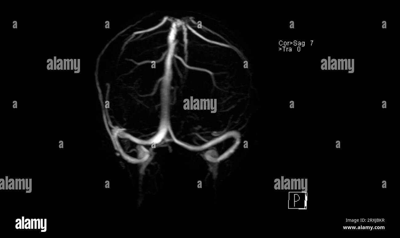 MRV cervello o risonanza magnetica venografia del cervello per la diagnosi anomalie nel drenaggio venoso del cervello Foto Stock