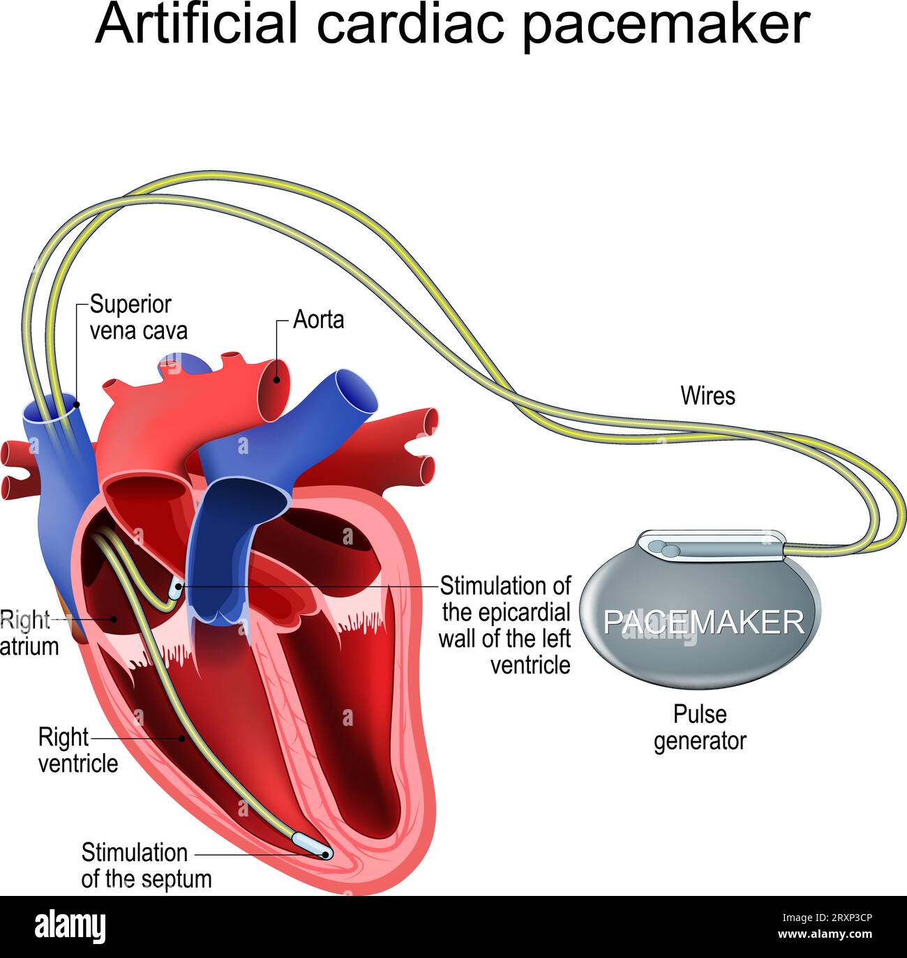 Pacemaker cardiaco artificiale. Impianto cardiaco. Trattamento di bradicardia, tachicardia, aritmia. Sezione trasversale di un cuore umano con generatore di impulsi Illustrazione Vettoriale