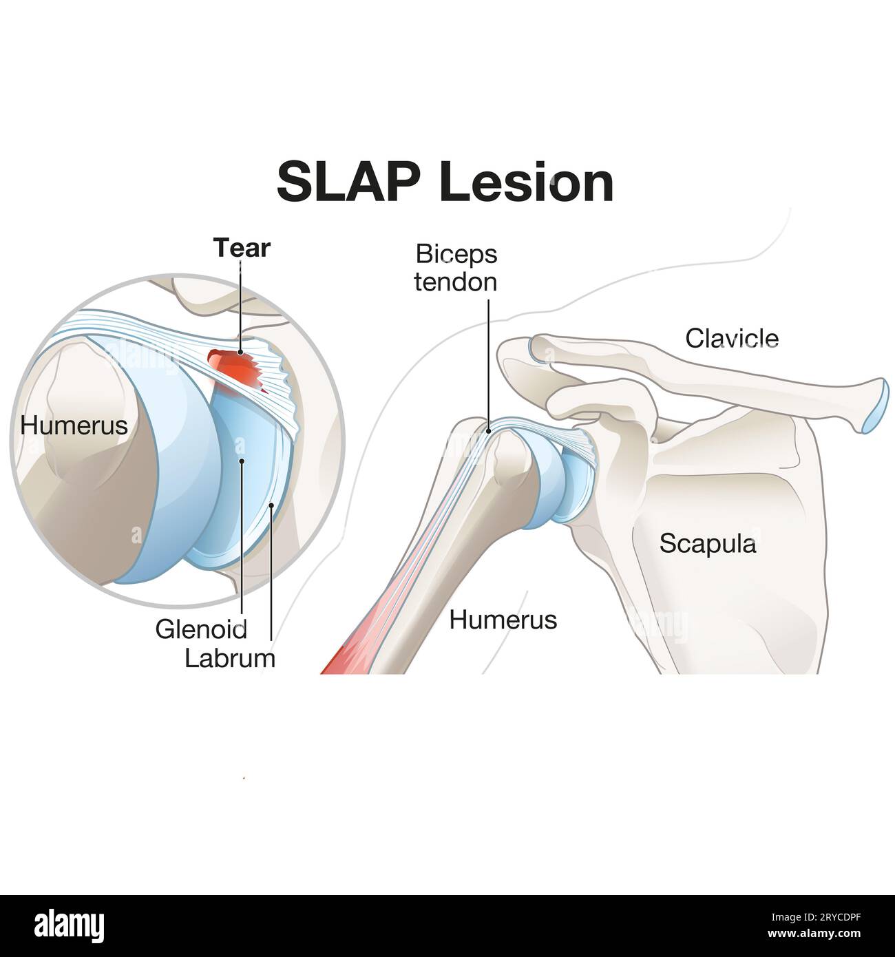 Una lesione DA SCHIAFFO nella spalla si riferisce a una lesione al labbro superiore, spesso causata da traumi o uso eccessivo, con conseguente dolore, instabilità e riduzione Foto Stock