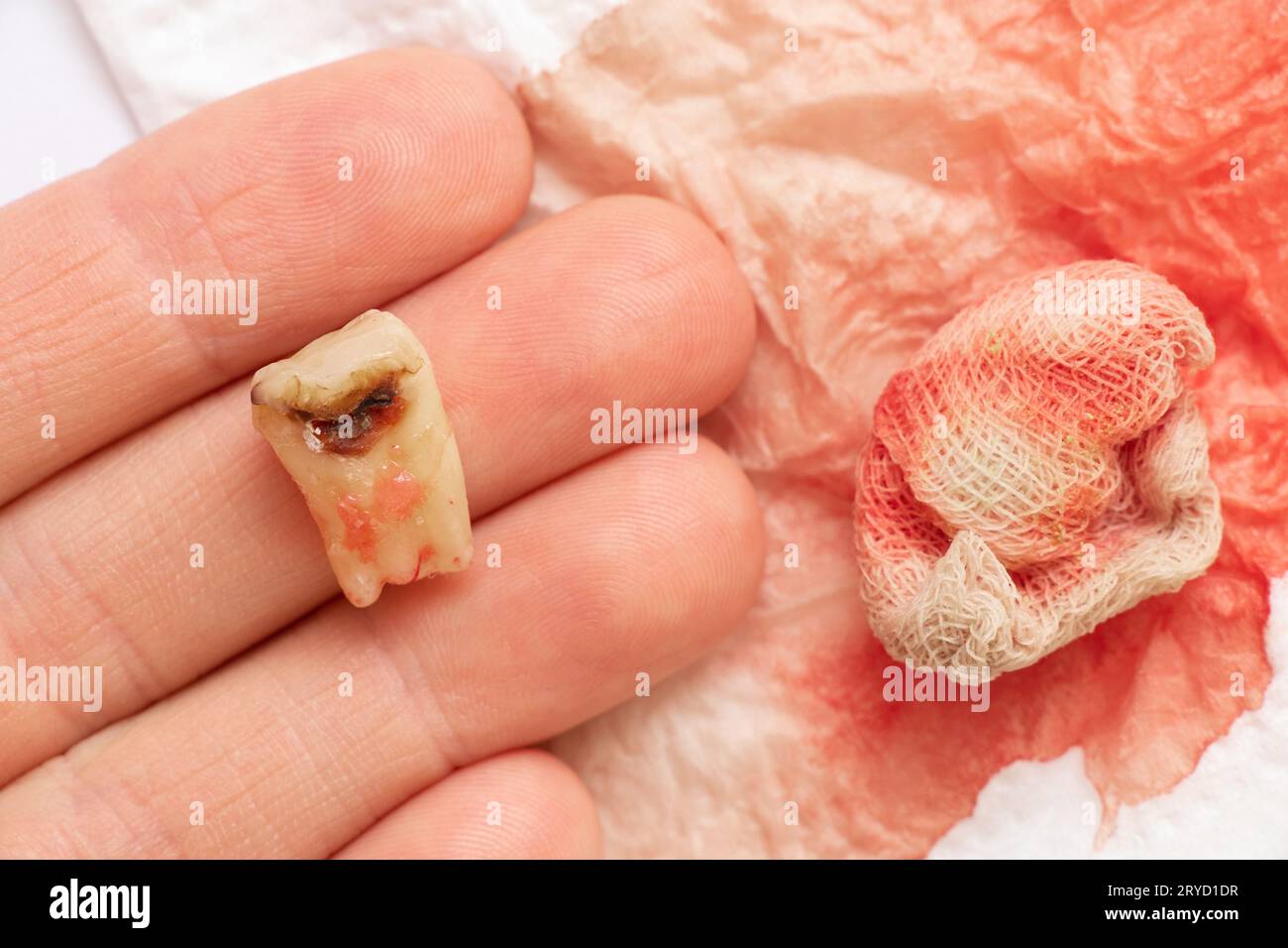 Una ragazza in mano tiene un dente estratto con un buco nero al centro del dente, primo piano sullo sfondo di una benda con il sangue, dentro Foto Stock