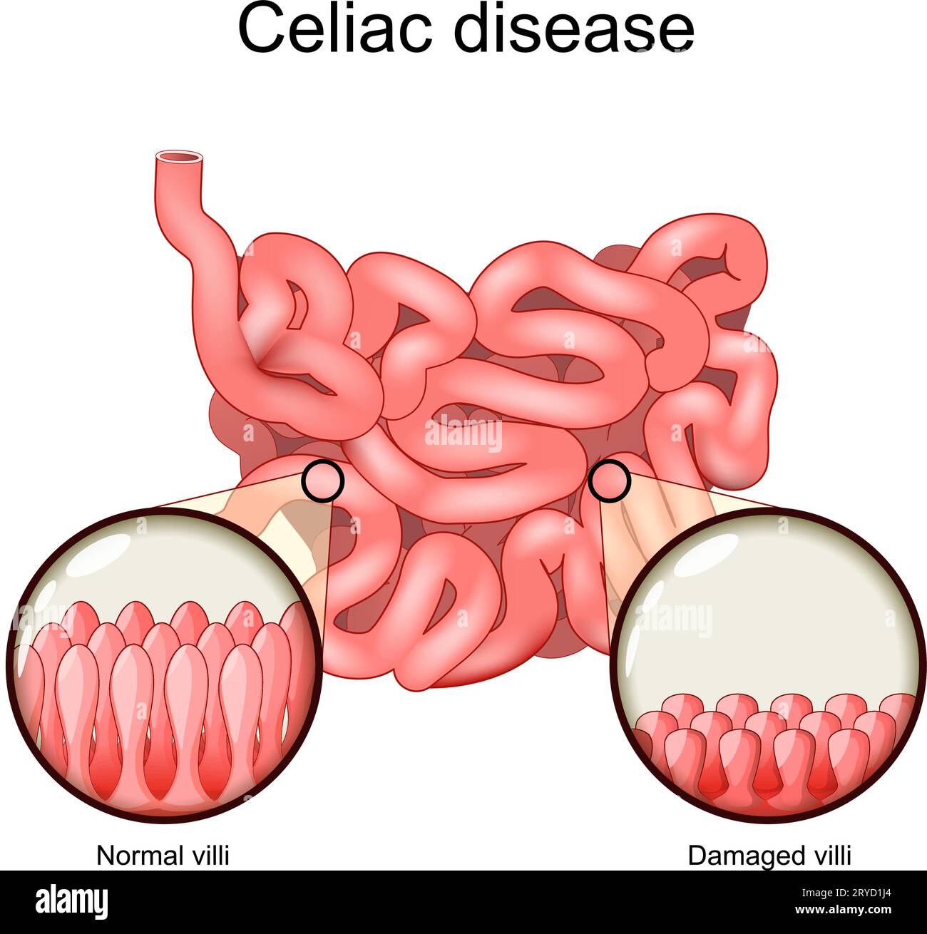 Celiachia. Sezione trasversale di un intestino tenue con villi normali e villi danneggiati. Intolleranza al glutine. Disturbo autoimmune e sensibilità al glutine Illustrazione Vettoriale