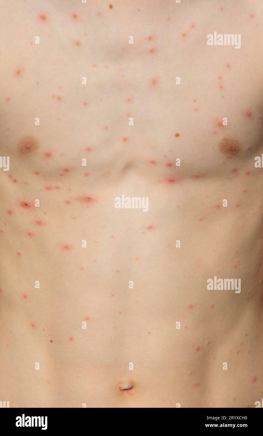 Eruzione cutanea della varicella su un corpo di un giovane ragazzo. La varicella è una malattia contagiosa causata dal virus varicella-zoster (VZV). Foto Stock