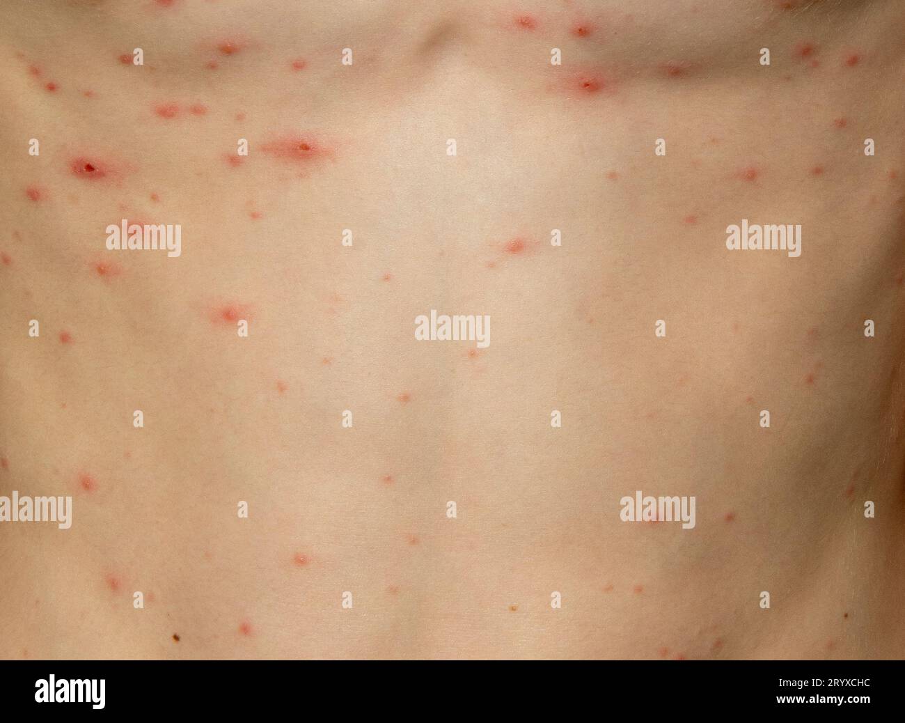 Eruzione cutanea della varicella su un corpo di un giovane ragazzo. La varicella è una malattia contagiosa causata dal virus varicella-zoster (VZV). Foto Stock