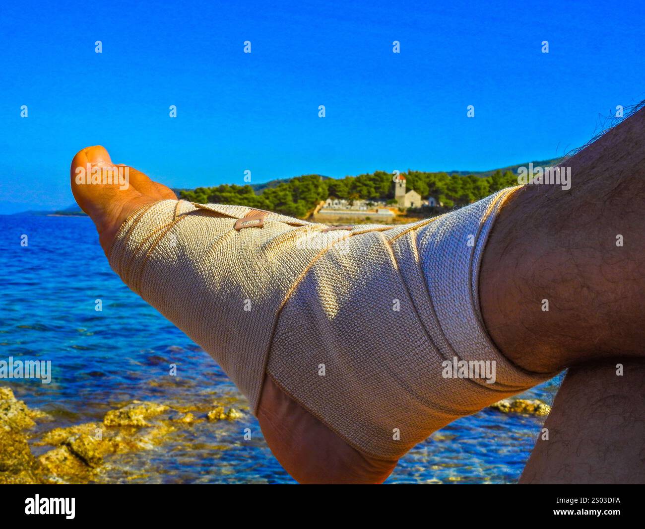 Lesioni al piede, gamba rotta avvolta in una benda durante le vacanze, incidente in bicicletta e ossa rotte in vacanza Foto Stock