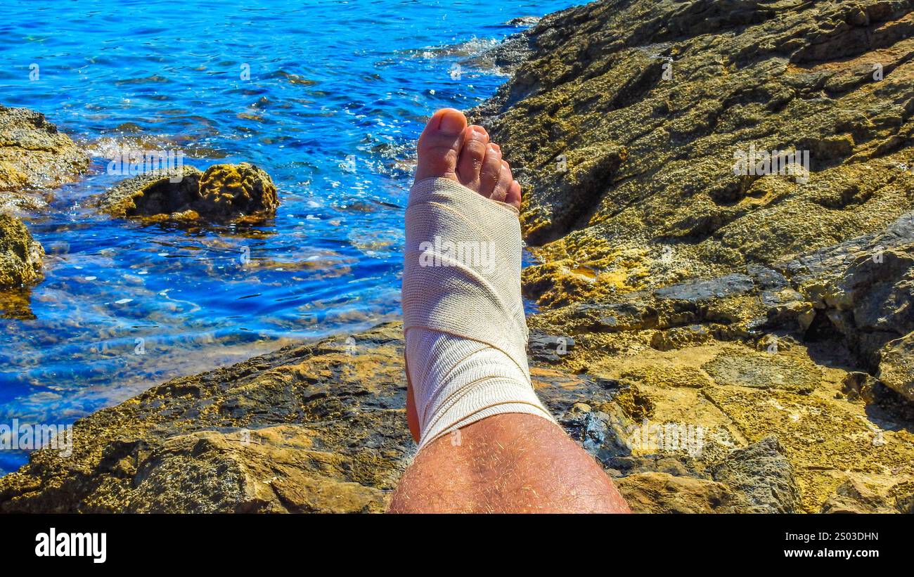 Lesioni al piede, gamba rotta avvolta in una benda durante le vacanze, incidente in bicicletta e ossa rotte in vacanza Foto Stock