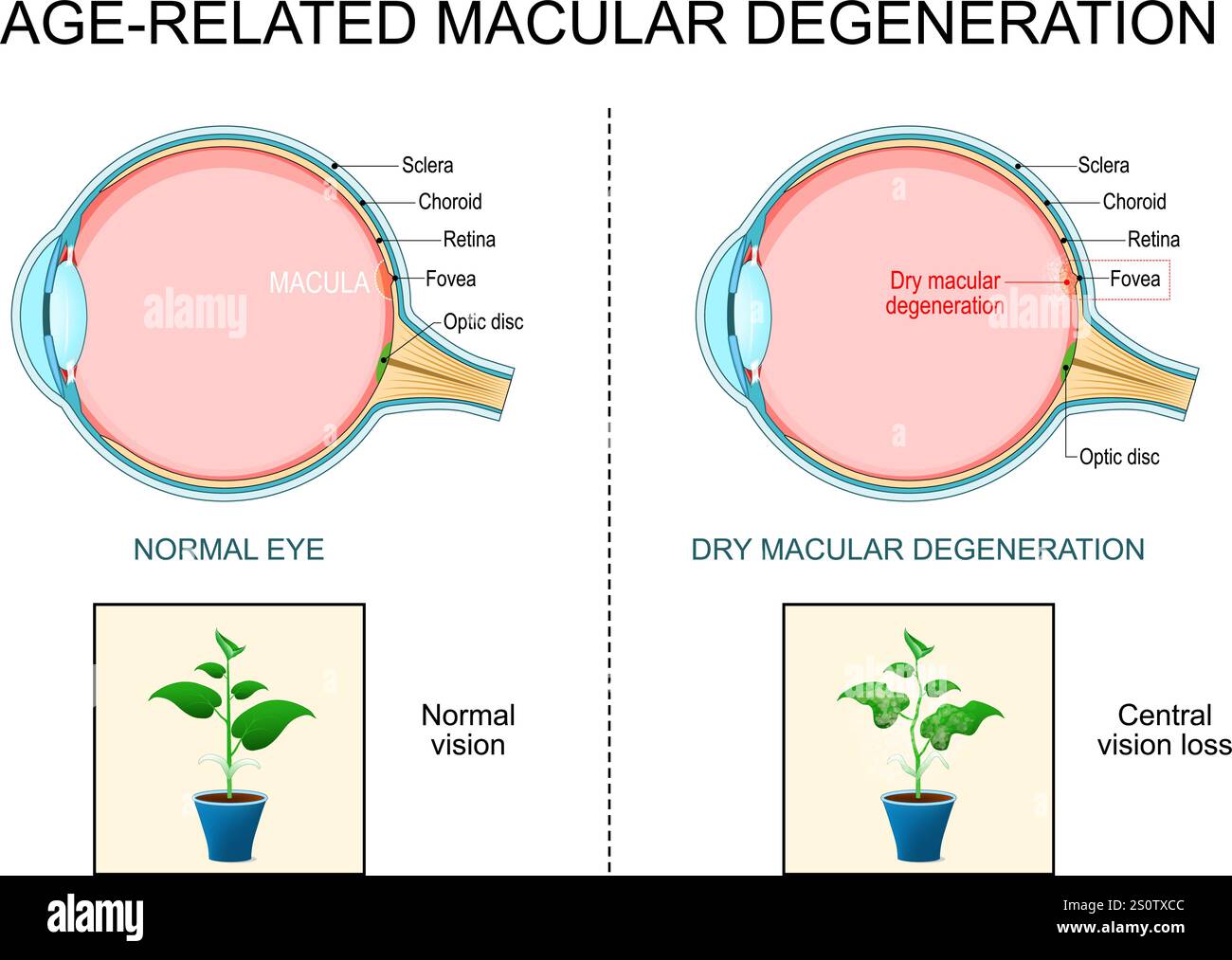 Degenerazione maculare. Degenerazione maculare secca correlata all'età. AMD. Sezione trasversale dell'occhio umano. Perdita della vista centrale. Primo piano di una macula, disco ottico, ch Illustrazione Vettoriale