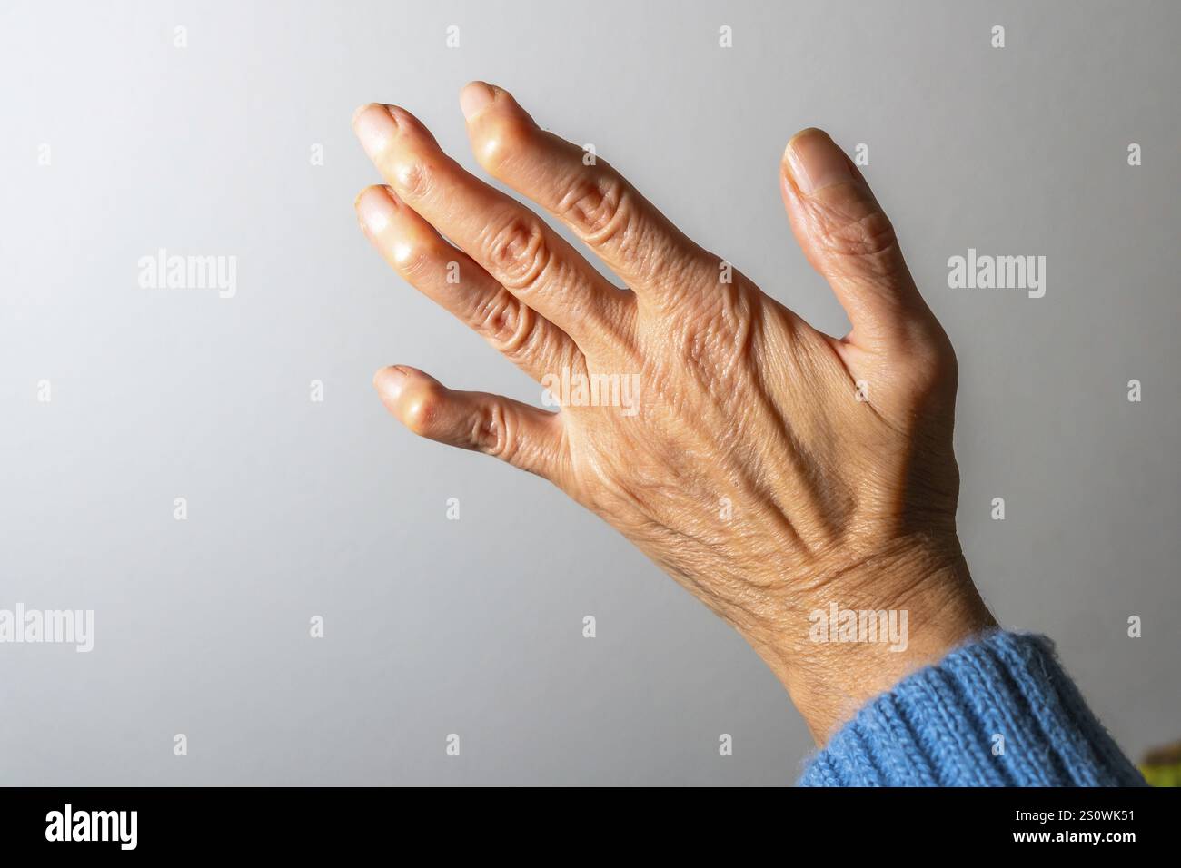 Primo piano della mano di una donna anziana, evidenziando le deformità visibili e il gonfiore delle dita causato dall'artrite Foto Stock