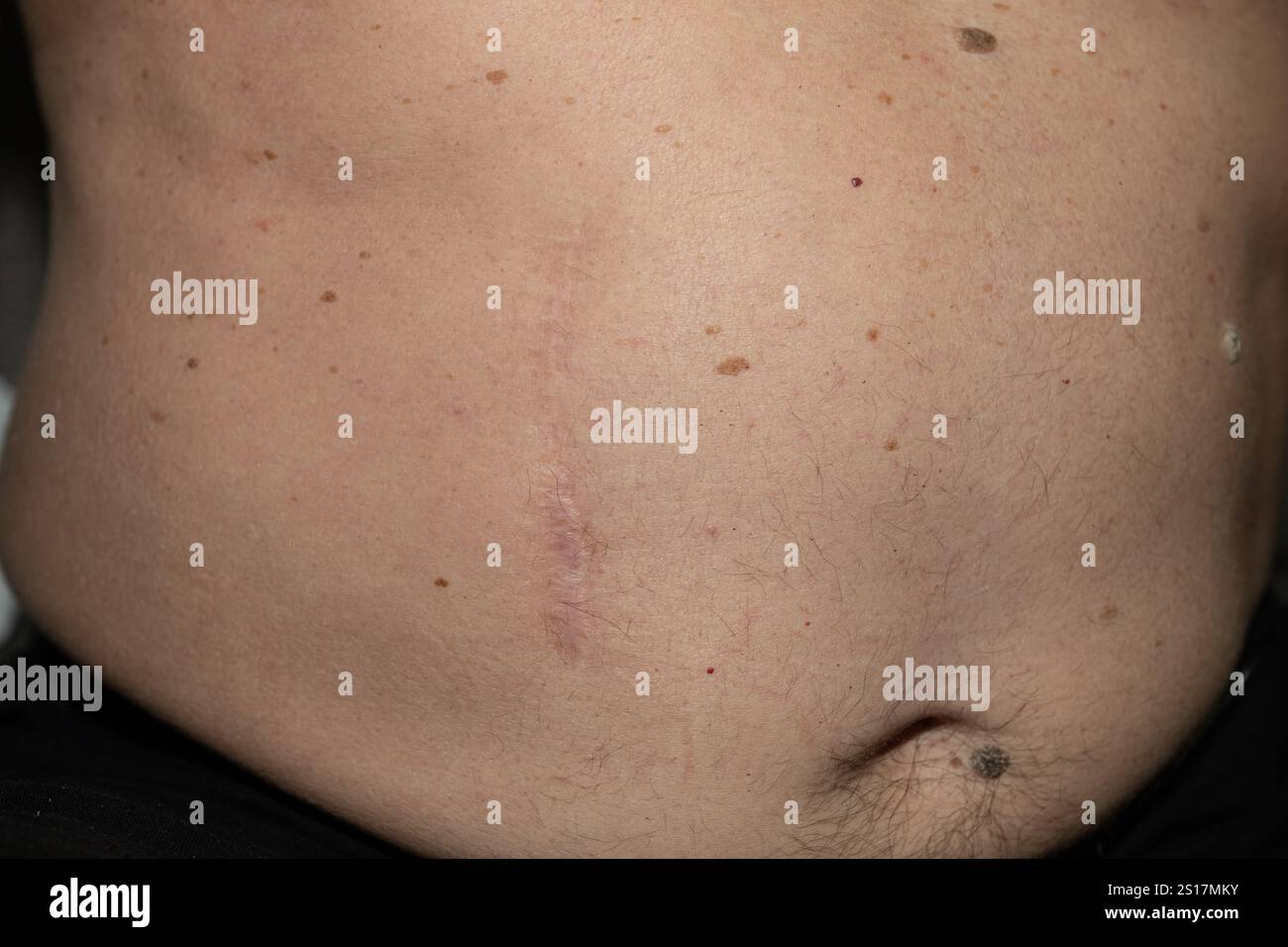 Una cicatrice chirurgica sul corpo di un vecchio. Intervento chirurgico alla vescica. Foto Stock