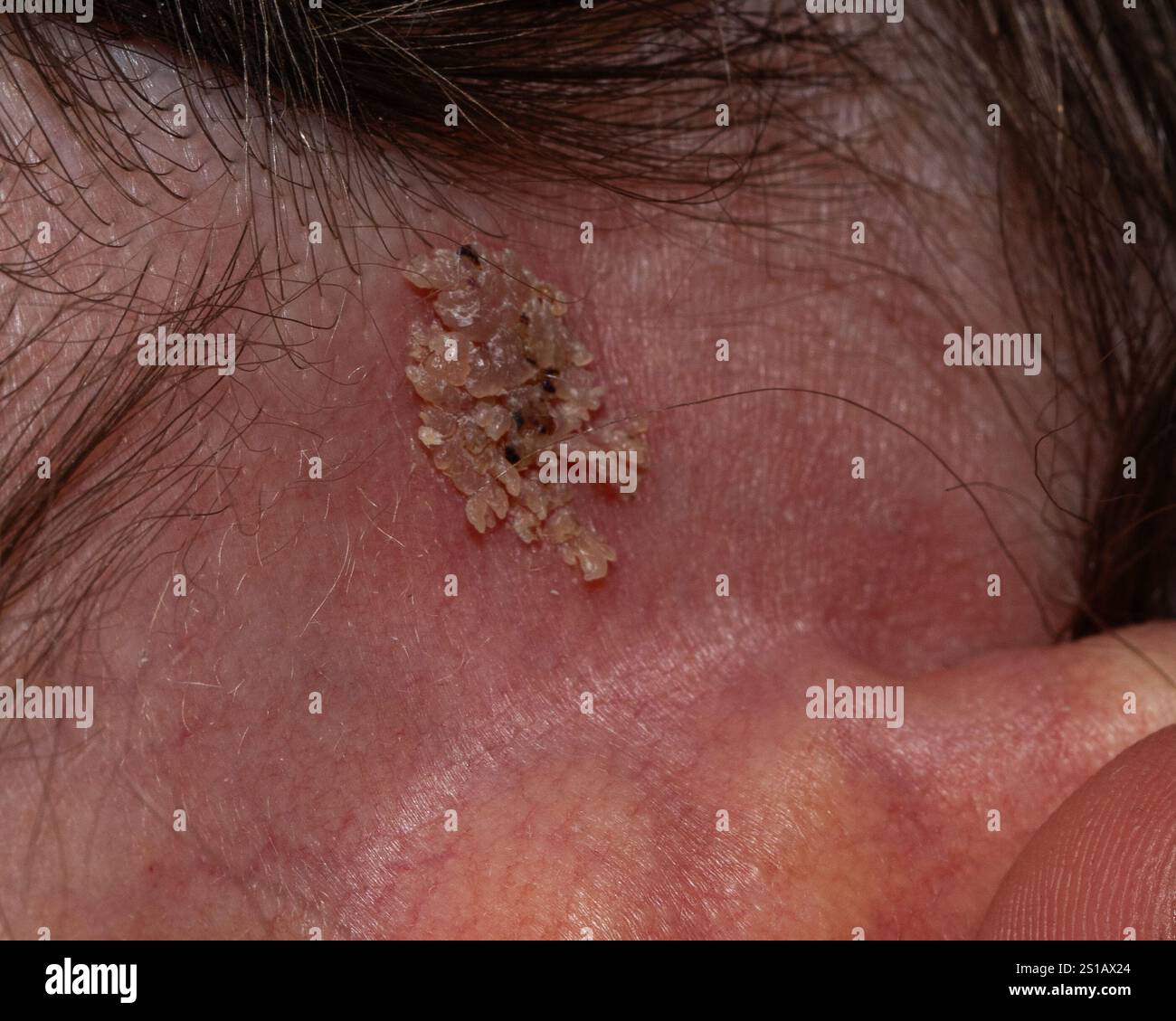 lesione squamosa e crosta sull'orecchio, circondata da pelle arrossata. La vista ravvicinata enfatizza la consistenza e la gravità delle condizioni della pelle, evidenziando Foto Stock