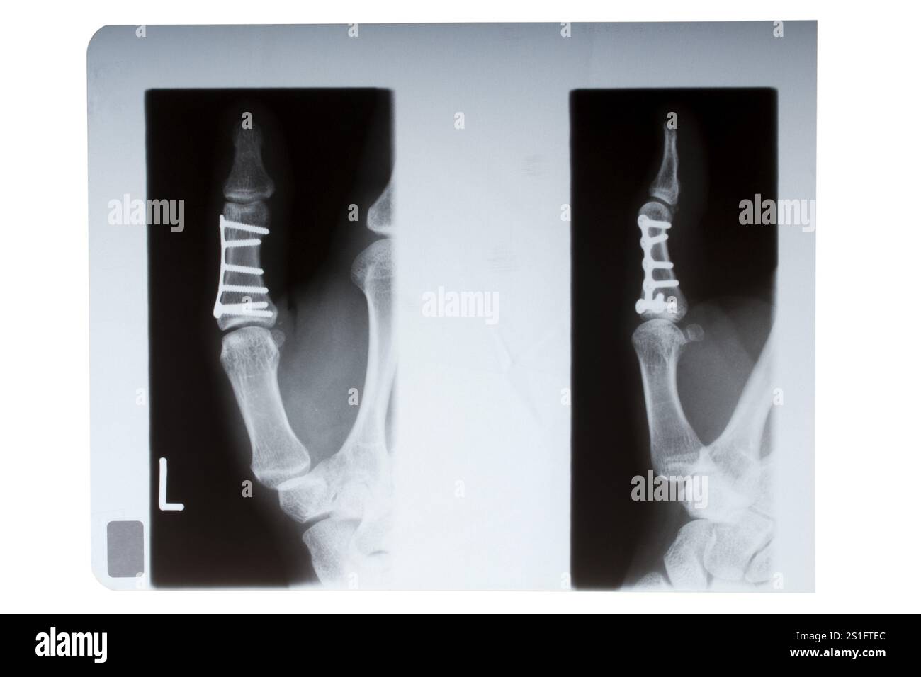 Osso del pollice inchiodato nell'immagine radiologica Foto Stock Osso del pollice inchiodato nell'immagine radiologica Foto Stock