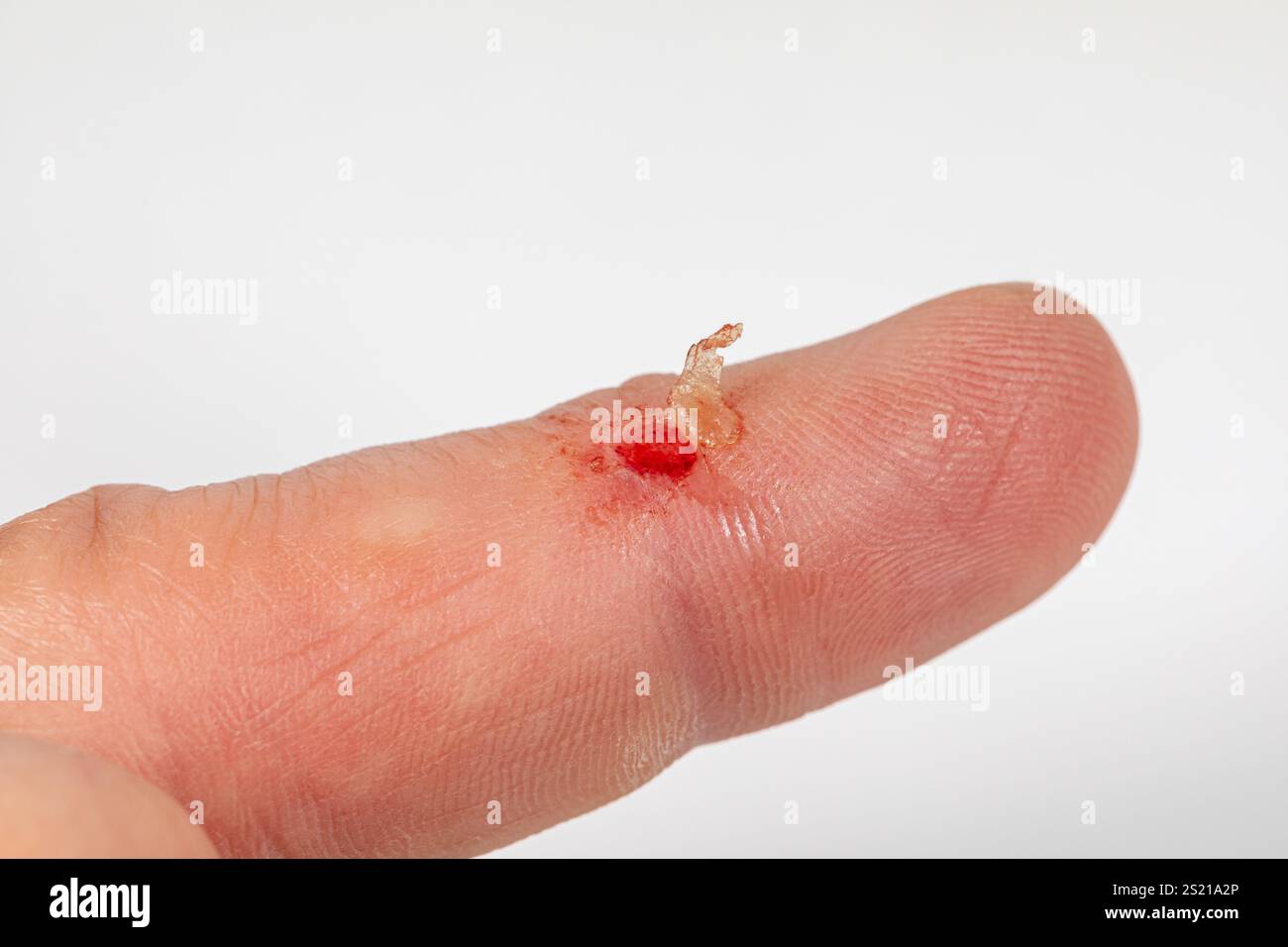 Lacerazione cutanea sul dito. Primo soccorso, riduzione delle lesioni e concetto di trattamento medico. Foto Stock