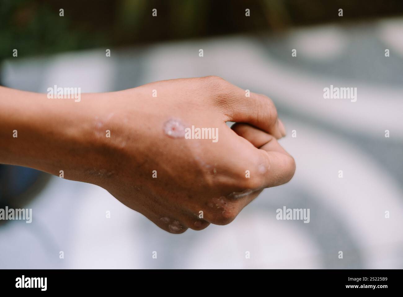 Primo piano di una cicatrice guarita sulla mano destra, che mostra pelle secca Foto Stock