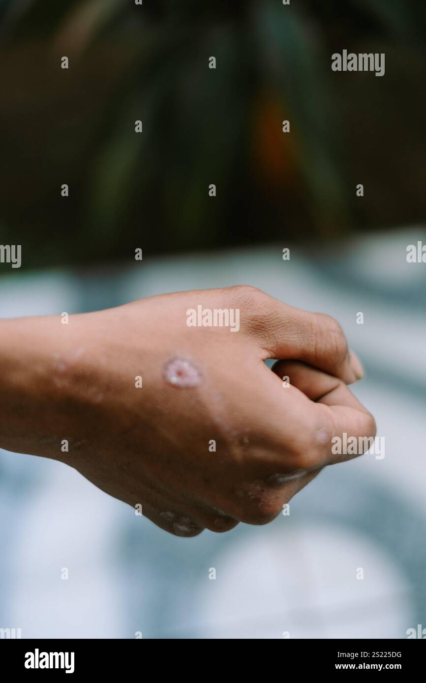 Primo piano di una cicatrice guarita sulla mano destra, che mostra pelle secca Foto Stock