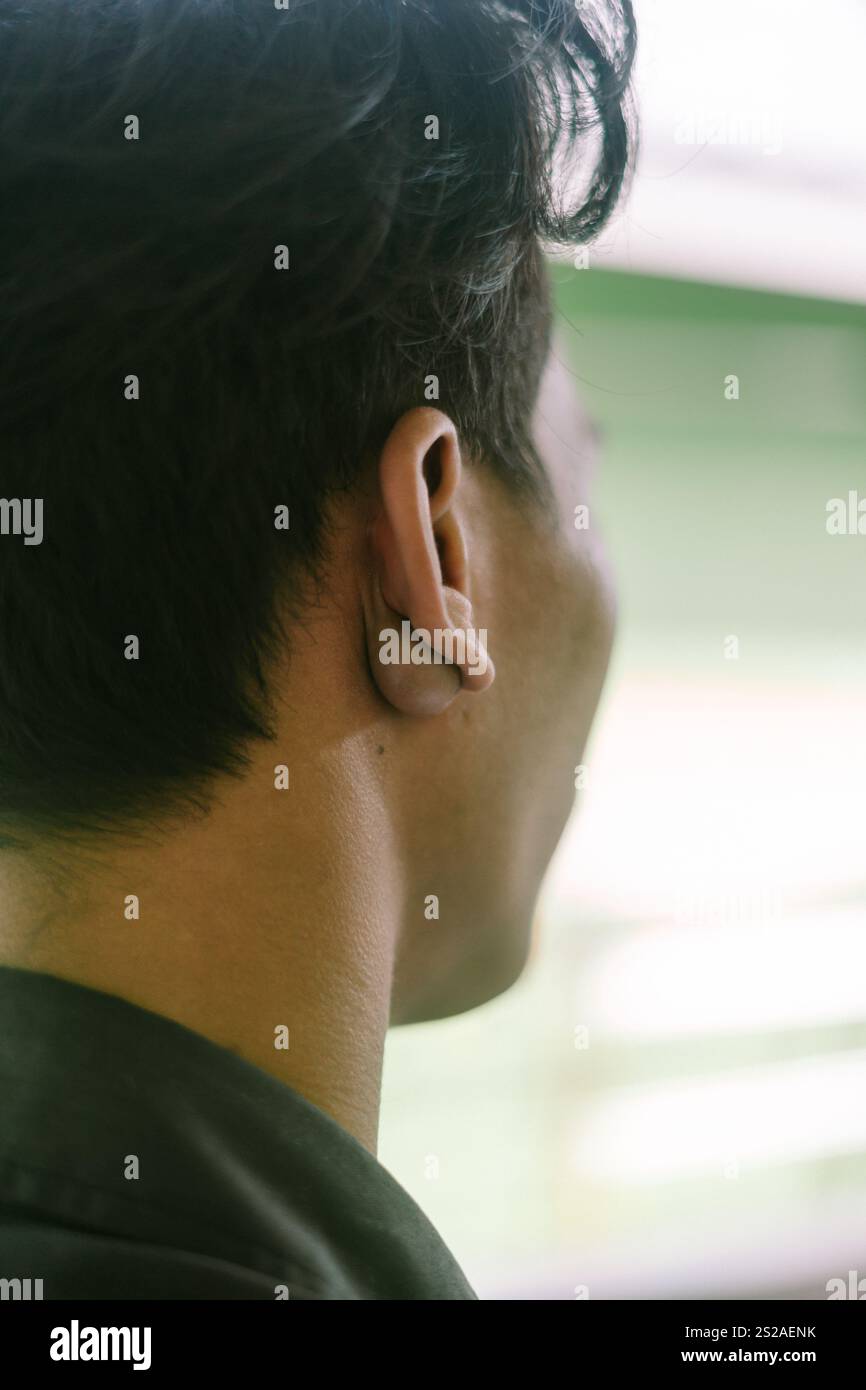 Un nodulo che somiglia a una polpa extra situata sopra il collo vicino all'orecchio, evidenziando una condizione fisica unica Foto Stock