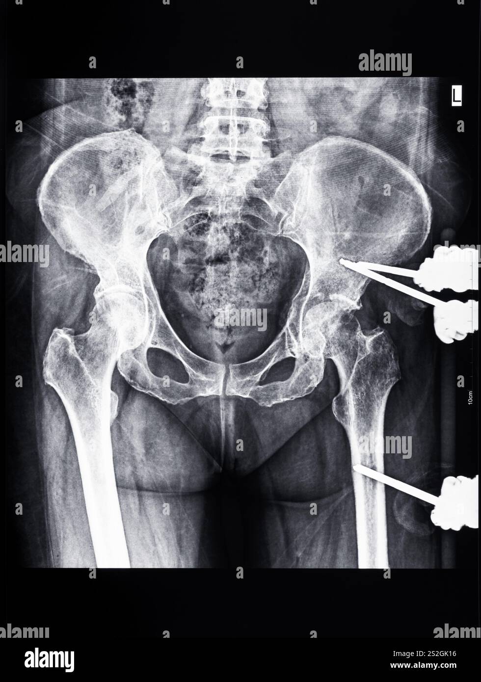 radiografia del bacino con dispositivo di fissaggio esterno fissato nelle ossa del femore e del bacino Foto Stock