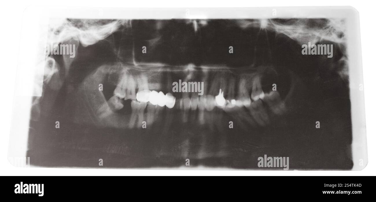 Immagine radiografica di mascelle umane con corona dentale isolata su sfondo bianco Foto Stock