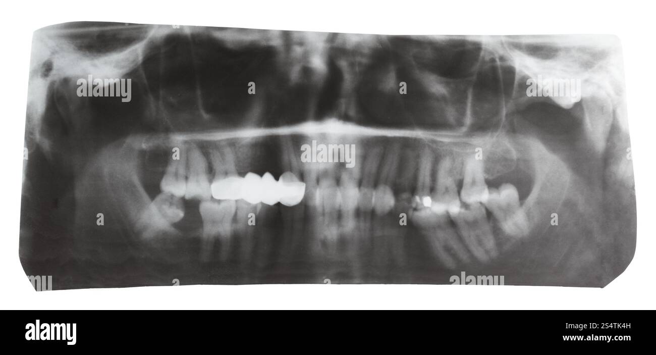Immagine radiografica dentale di mascelle umane isolate su sfondo bianco Foto Stock